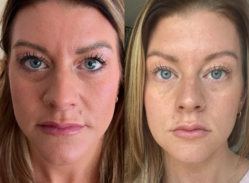 Injectables before and after — fine lines and wrinkles
