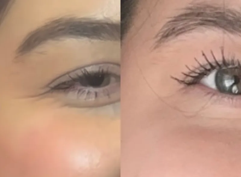 Injectables — Fine Lines & Wrinkles before and after result 4