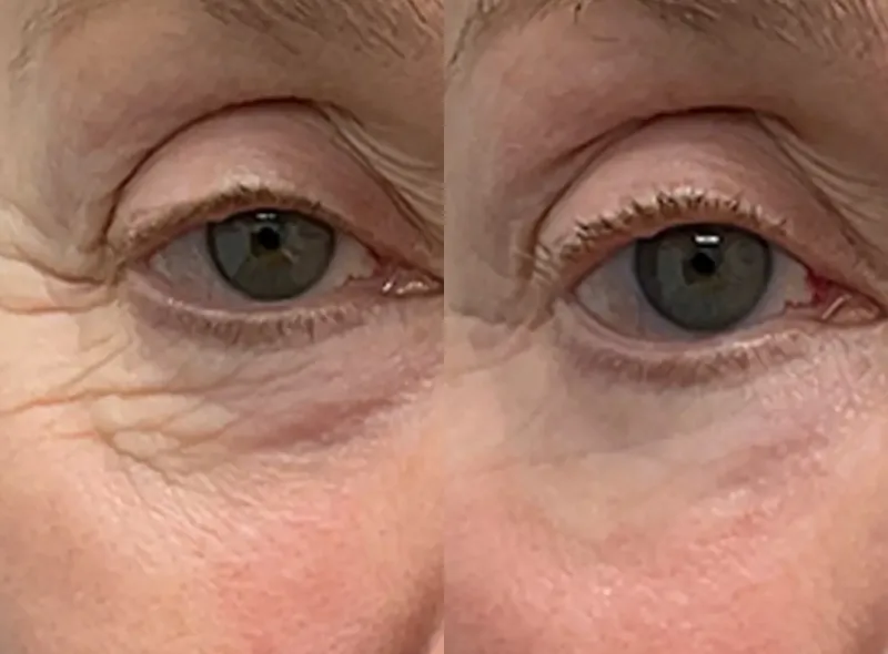 Morpheus8 — Improved Texture before and after result 11