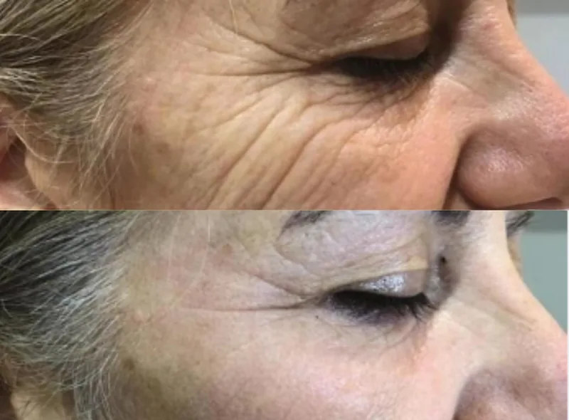 Morpheus8 before and after — improved skin texture