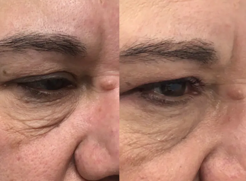 Morpheus8 — Improved Texture before and after result 13