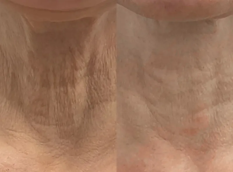 Morpheus8 — Improved Texture before and after result 14