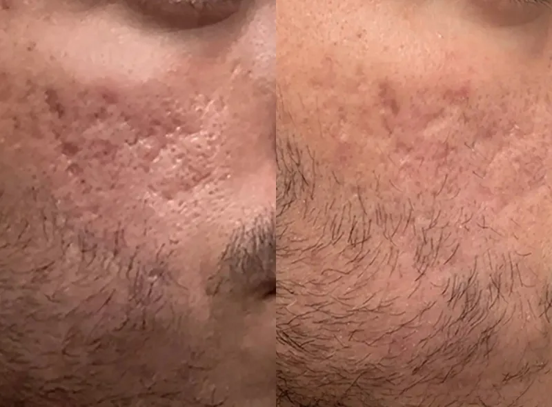 Morpheus8 — Improved Texture before and after result 15