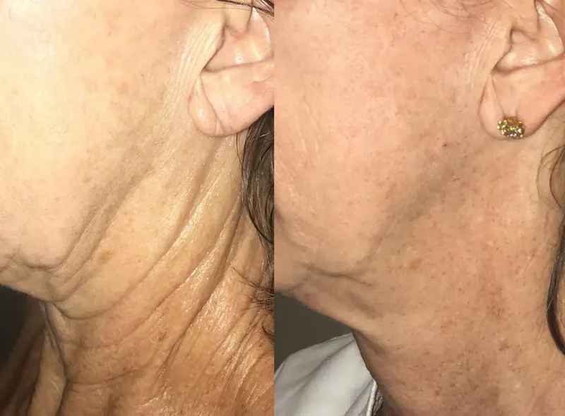 Morpheus8 — Improved Texture before and after result 16
