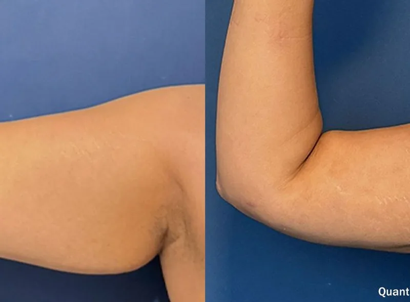 QuantumRF — Skin Tightening before and after result 5