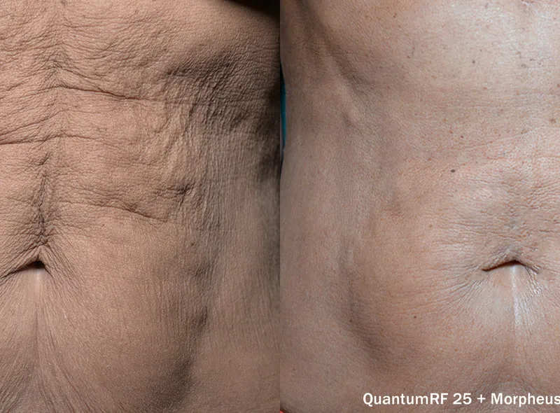 QuantumRF before and after — skin tightening
