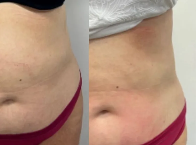 Cryoskin — Body Contouring before and after result 10