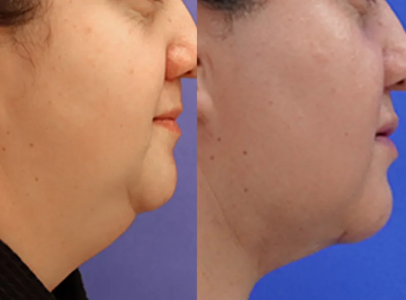 QuantumRF — Skin Tightening before and after result 7