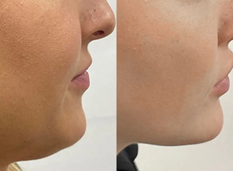 QuantumRF — Skin Tightening before and after result 8