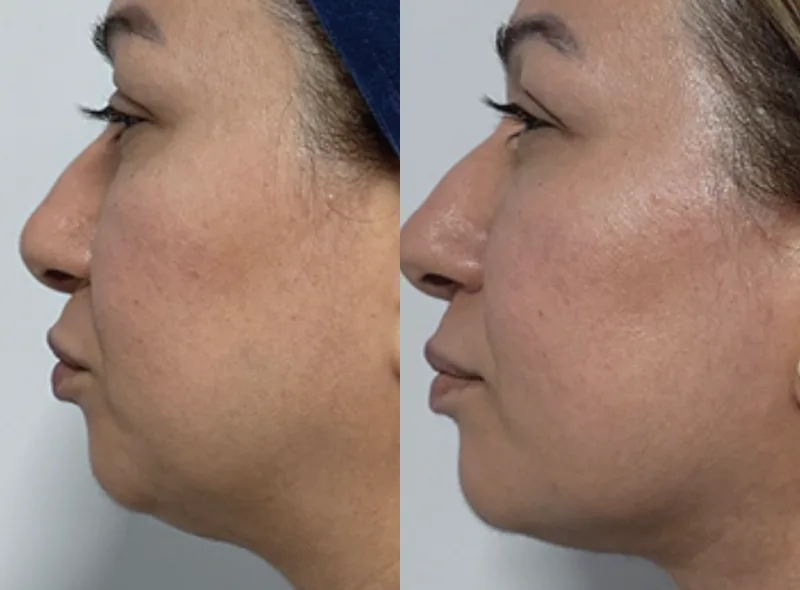 QuantumRF — Skin Tightening before and after result 9