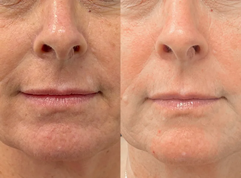 Solaria CO₂ before and after — skin resurfacing