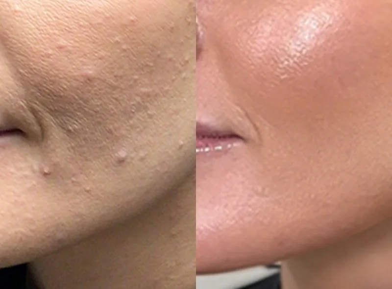 Solaria CO₂ — Skin Resurfacing before and after result 18