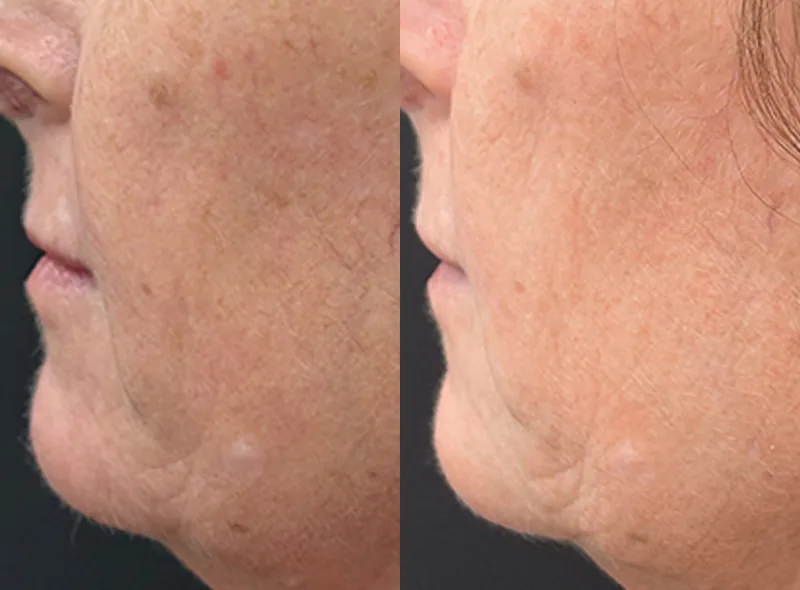 Solaria CO₂ — Skin Resurfacing before and after result 19