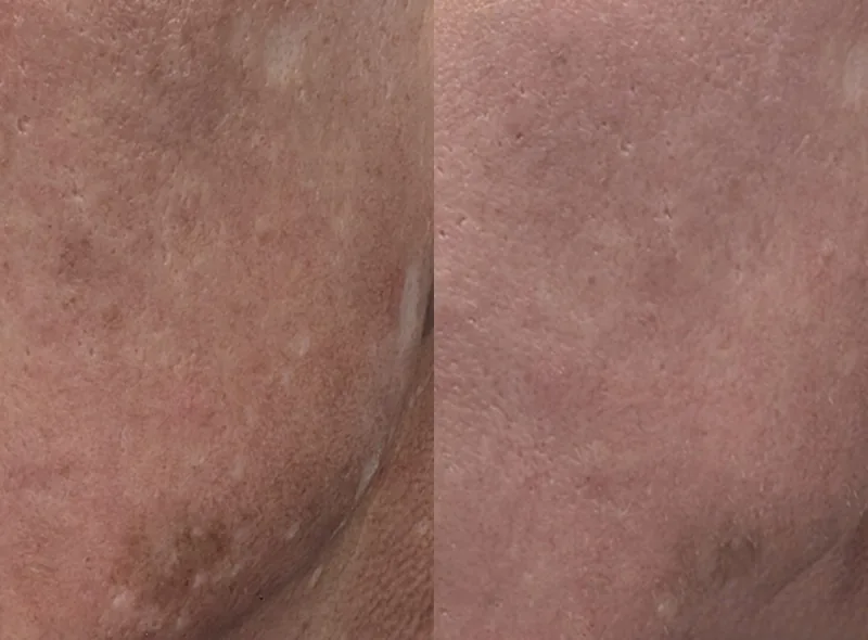 Solaria CO₂ — Skin Resurfacing before and after result 20