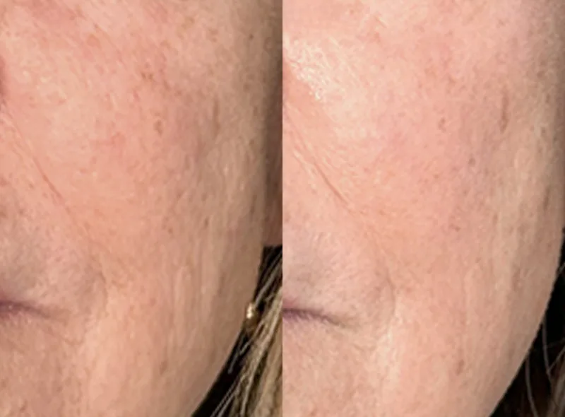 Solaria CO₂ — Skin Resurfacing before and after result 21
