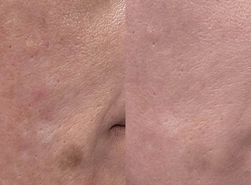 Solaria CO₂ — Skin Resurfacing before and after result 22